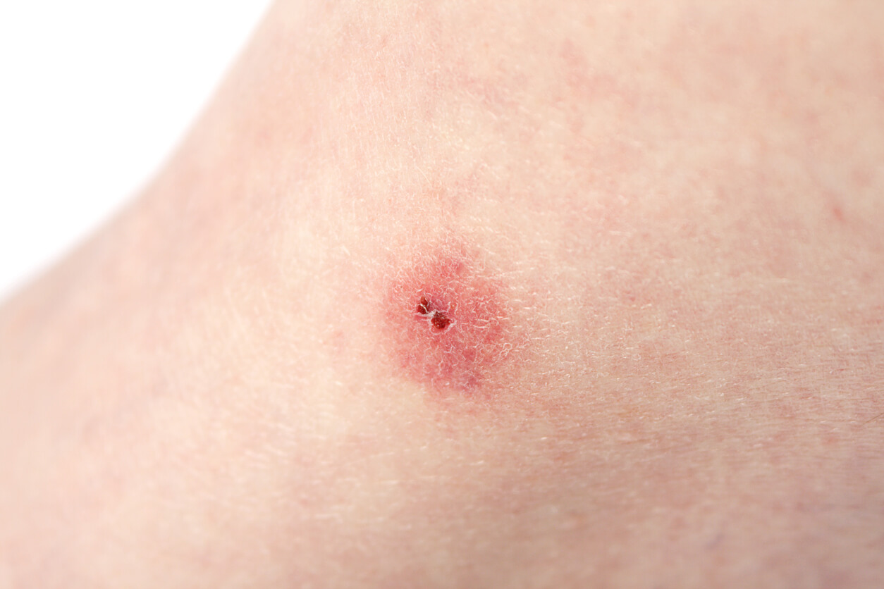 eritema papula excoriacion flictena mordedura araña aracnido dientes picadura piel blanca