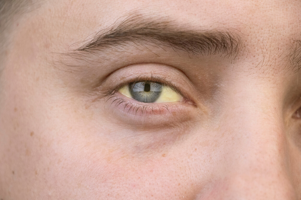 Femme aux yeux jaunes, caractéristiques de l'hépatite C.