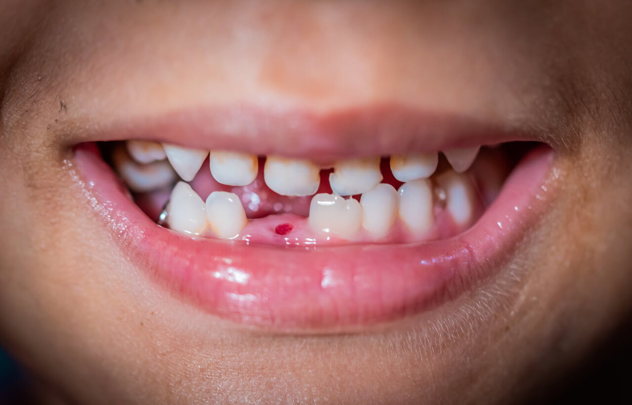 Enfant avec une dent de lait tombée.