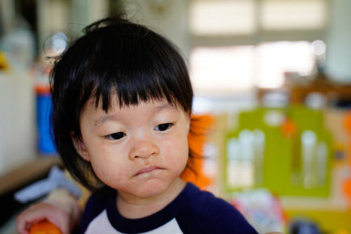 Pitiriasis rosada en niños: causas, síntomas y tratamiento