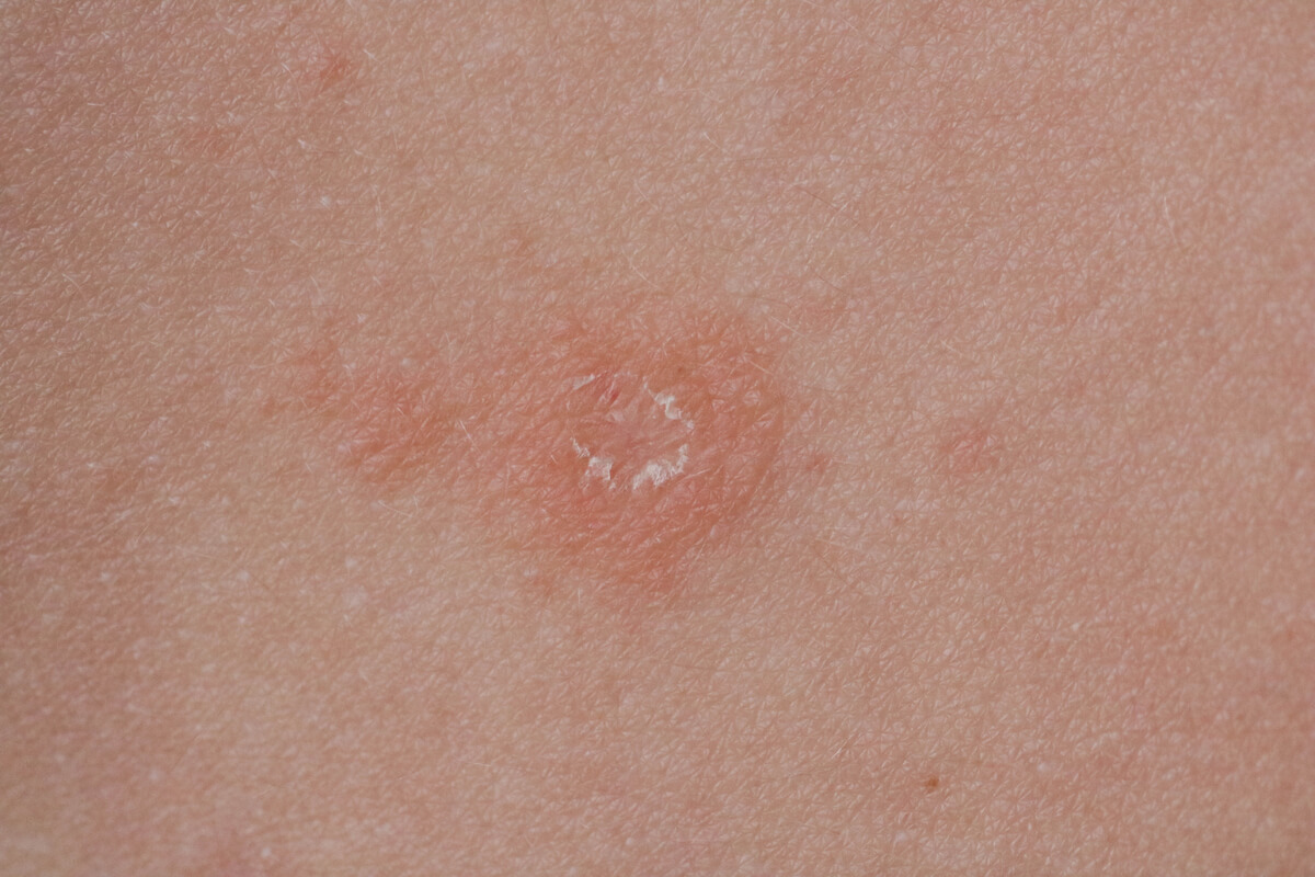 L'un des symptômes du pityriasis rosé.