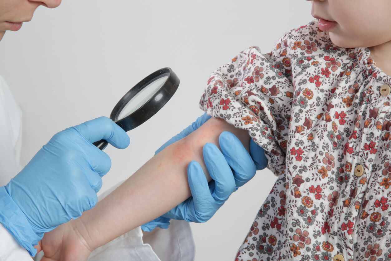 En hudläkare tittar på ett utslag på ett barns arm.