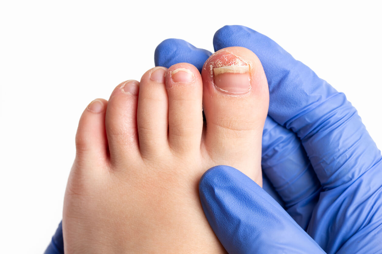 hongo micosis una pie hallux dedo onicomicosis mano guante dermatologo medico evaluacion