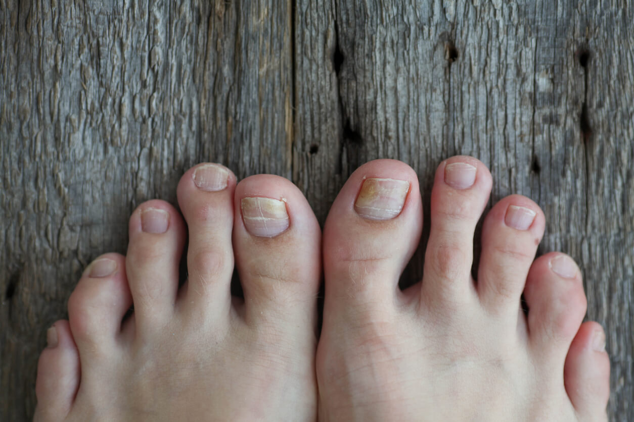¿Cómo tratar los hongos en las uñas de los niños?