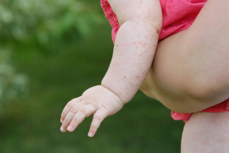 Sarna en bebés: síntomas, causas y tratamiento