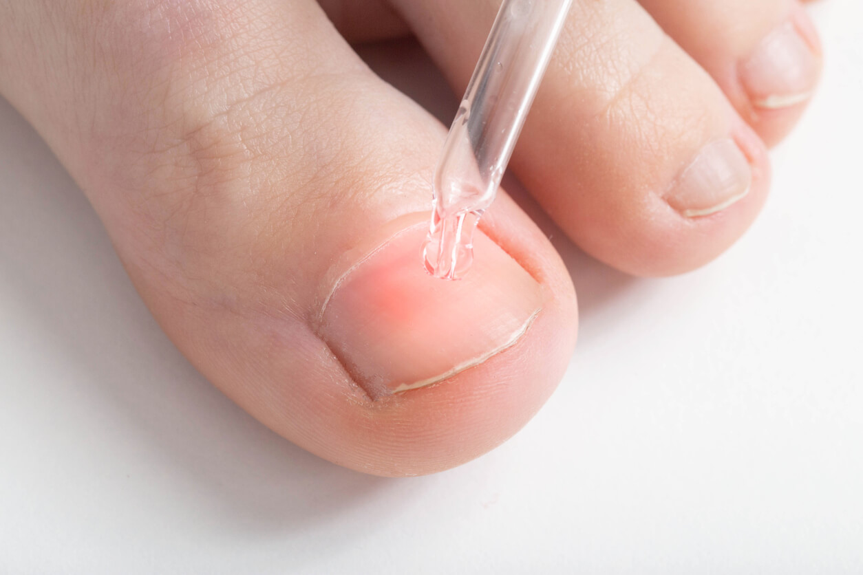 Traitement pour les mycoses des ongles de pied;