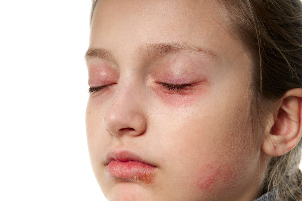 fille bébé visage eczéma dermatite atopique allergique cercles rouges sous les yeux œdème paupière paupières gonflées visage fatigué yeux fermés