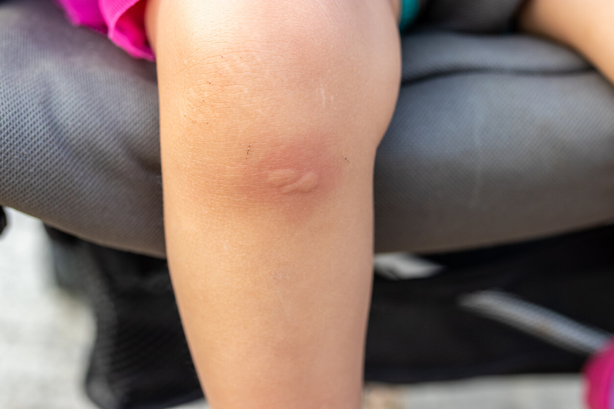 prurigo simple infantil lesion papula rodilla piel nino eritema
