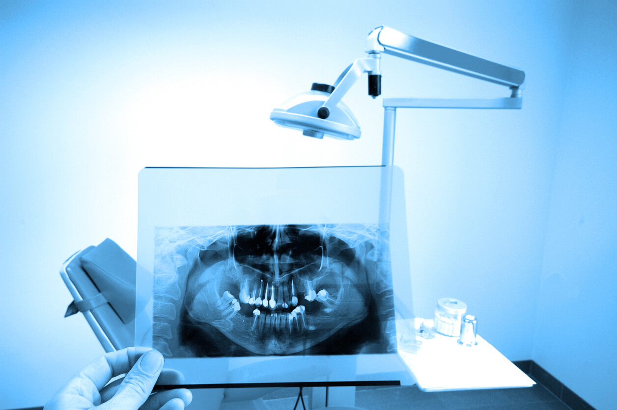 Radiografía dental: lo que debes saber