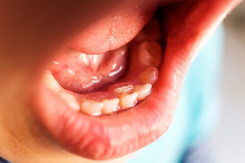 ¿Qué son los dientes de tiburón en la infancia?