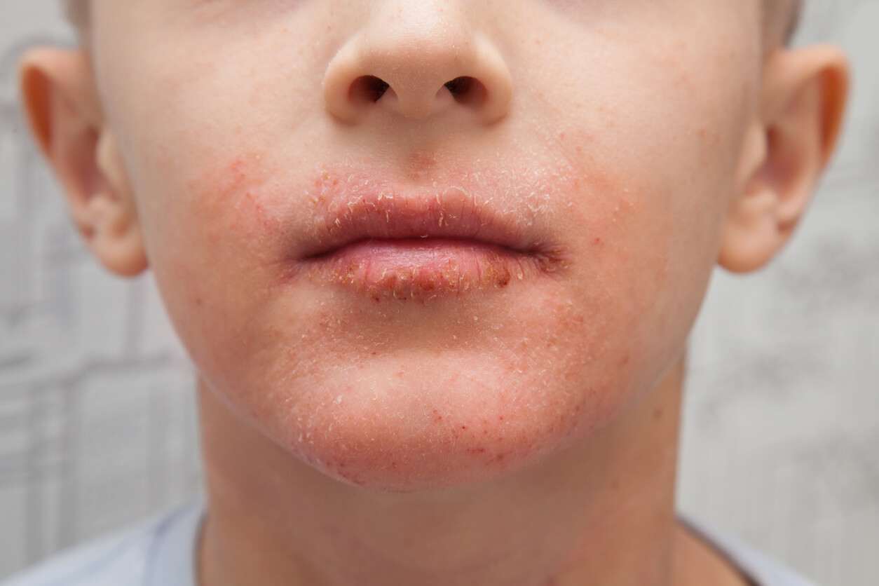 dermatitis atopica piel descamada infeccion labio mejilla nino joven piel seca