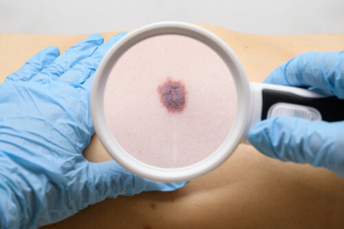 Nevus congénito: todo lo que debes saber