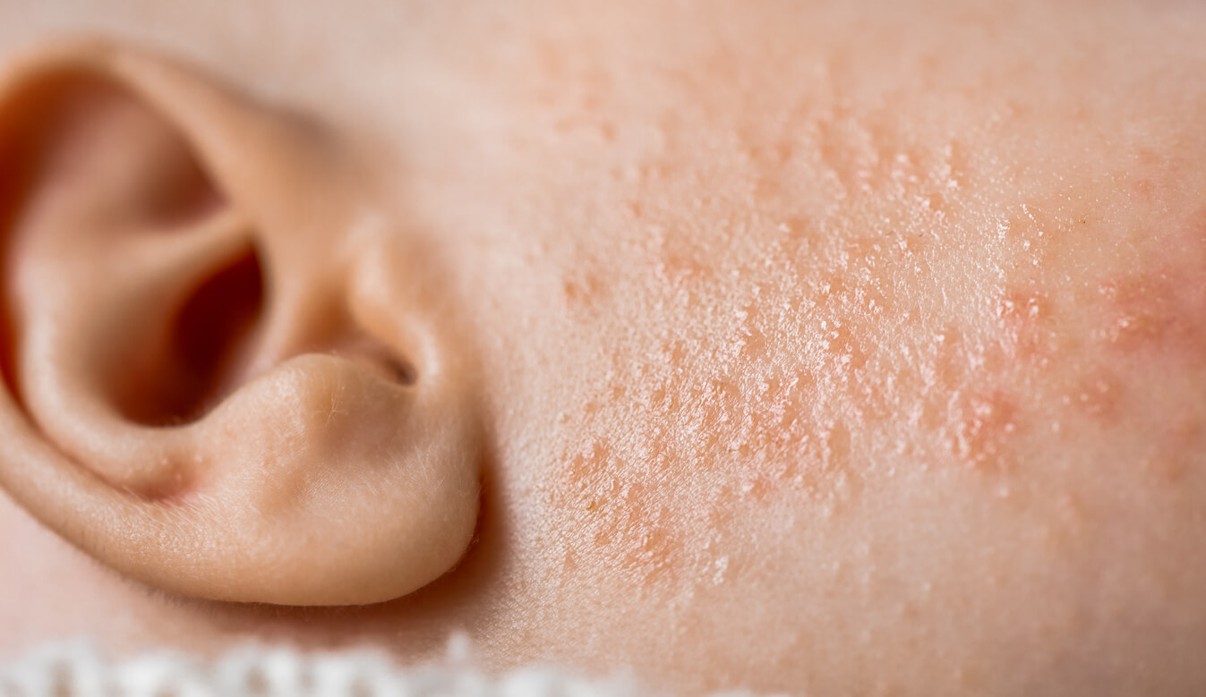 dermatite atópica eczema rosto bebê bochecha