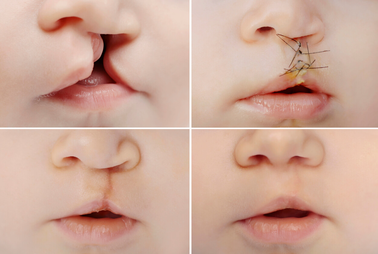 correzione della sequenza tempi chirurgici intervento di riparazione correttiva labbro leporino palatoschisi bambino