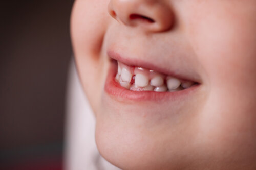 ¿Qué hacer si a tu hijo no se le caen los dientes de leche?