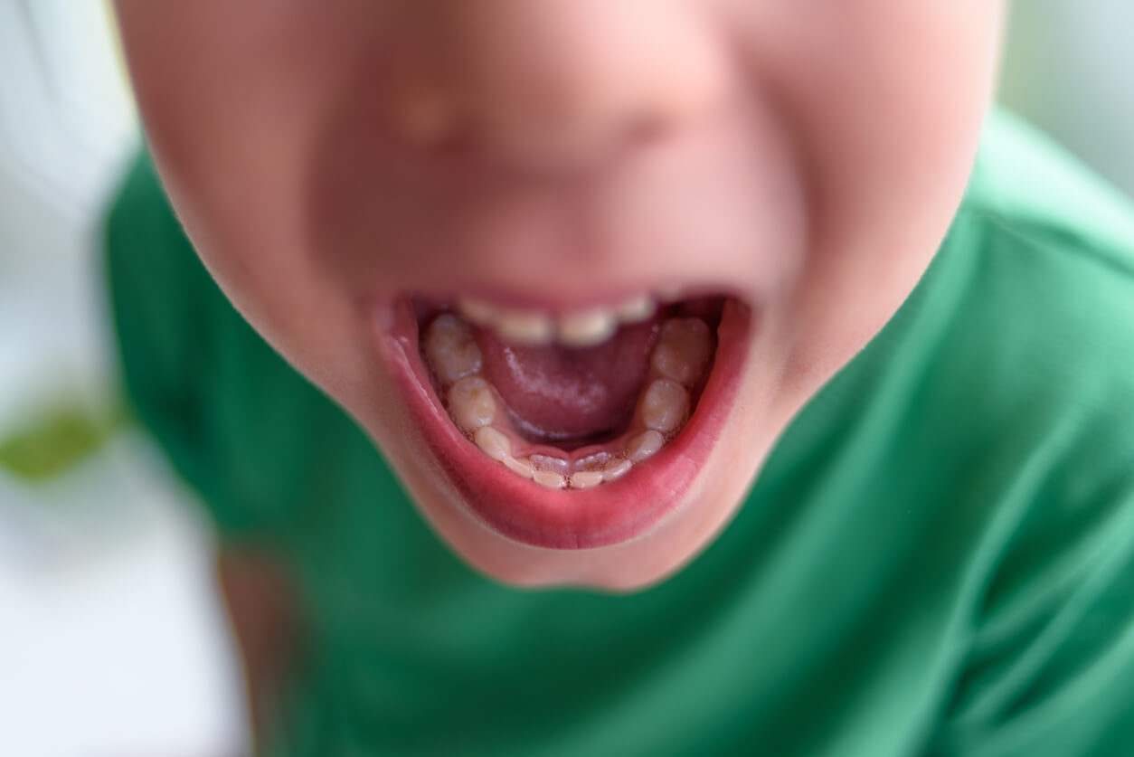 Doble fila de dientes en niños: ¿qué hacer?