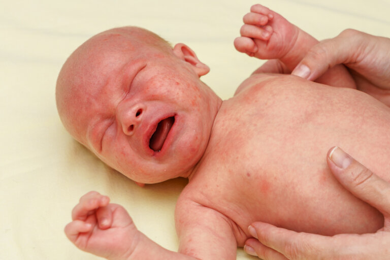Petequias en el bebé: causas, síntomas y tratamiento