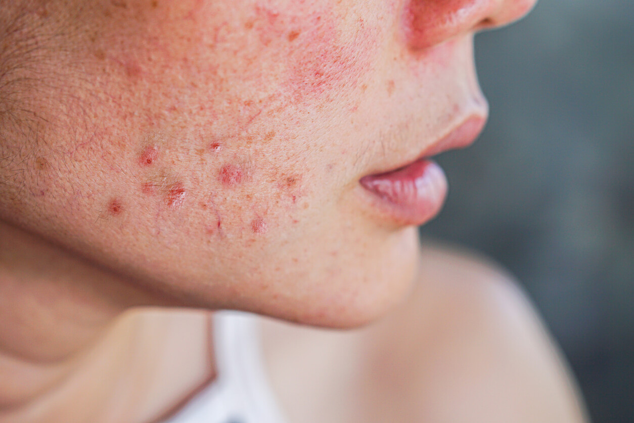 A woman with acne.