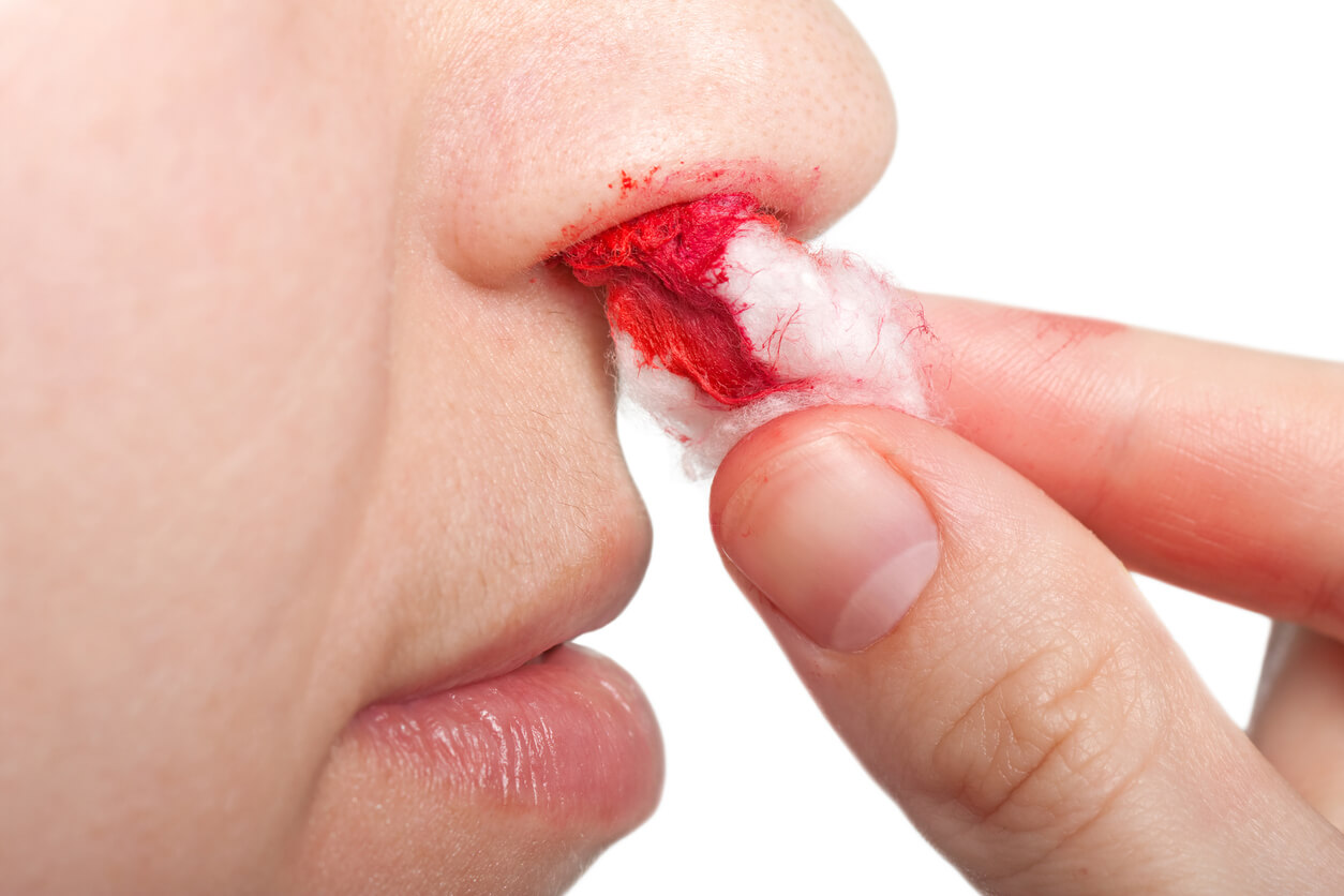 cara nariz mujer sangrado nasal epistaxis