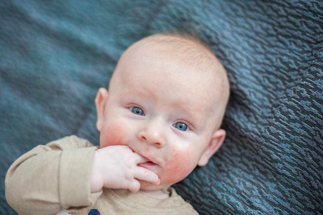 bebê com dermatite atópica eczema bochechas rosto