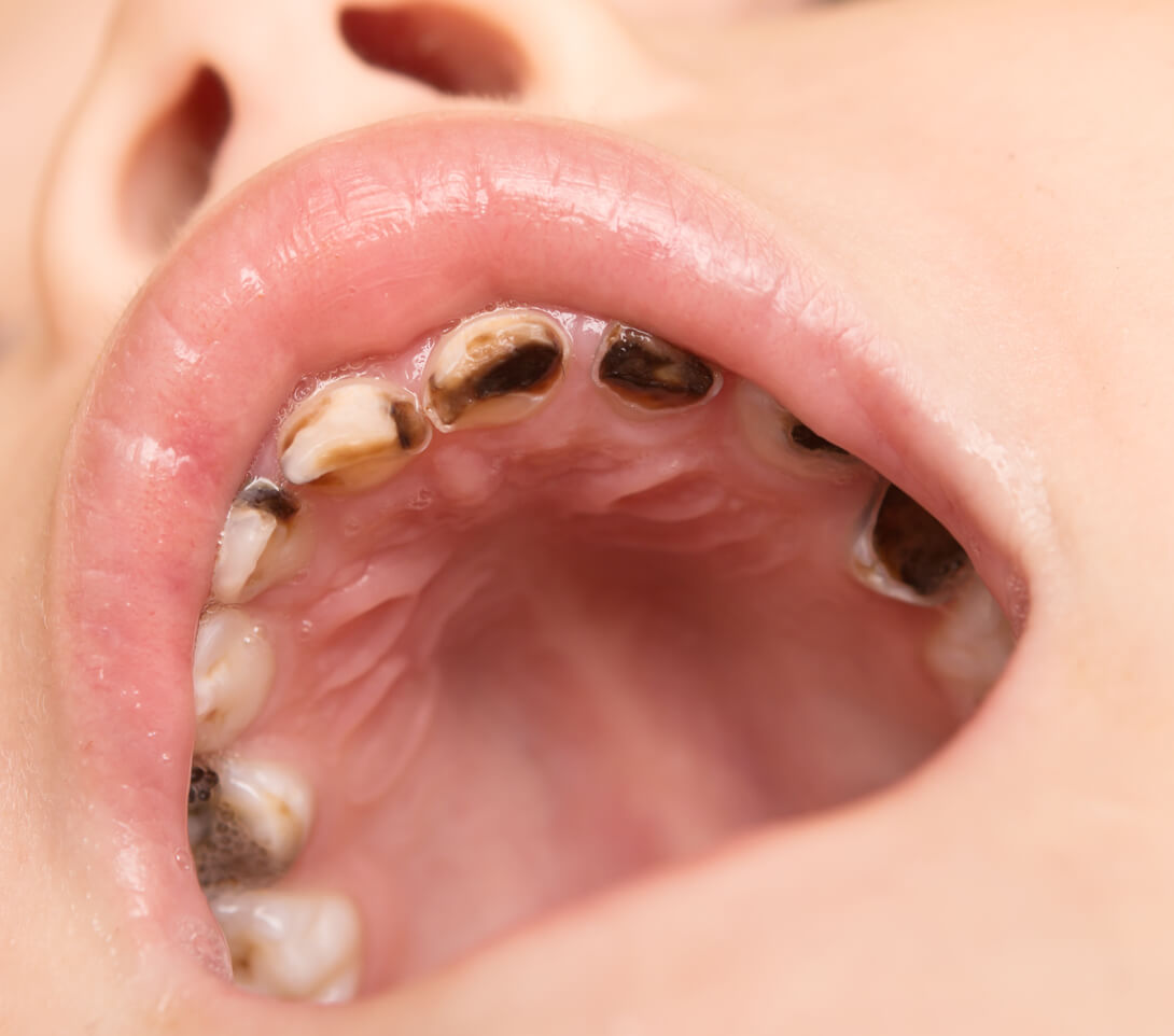 Dentes de leite escurecidos na boca de uma criança.