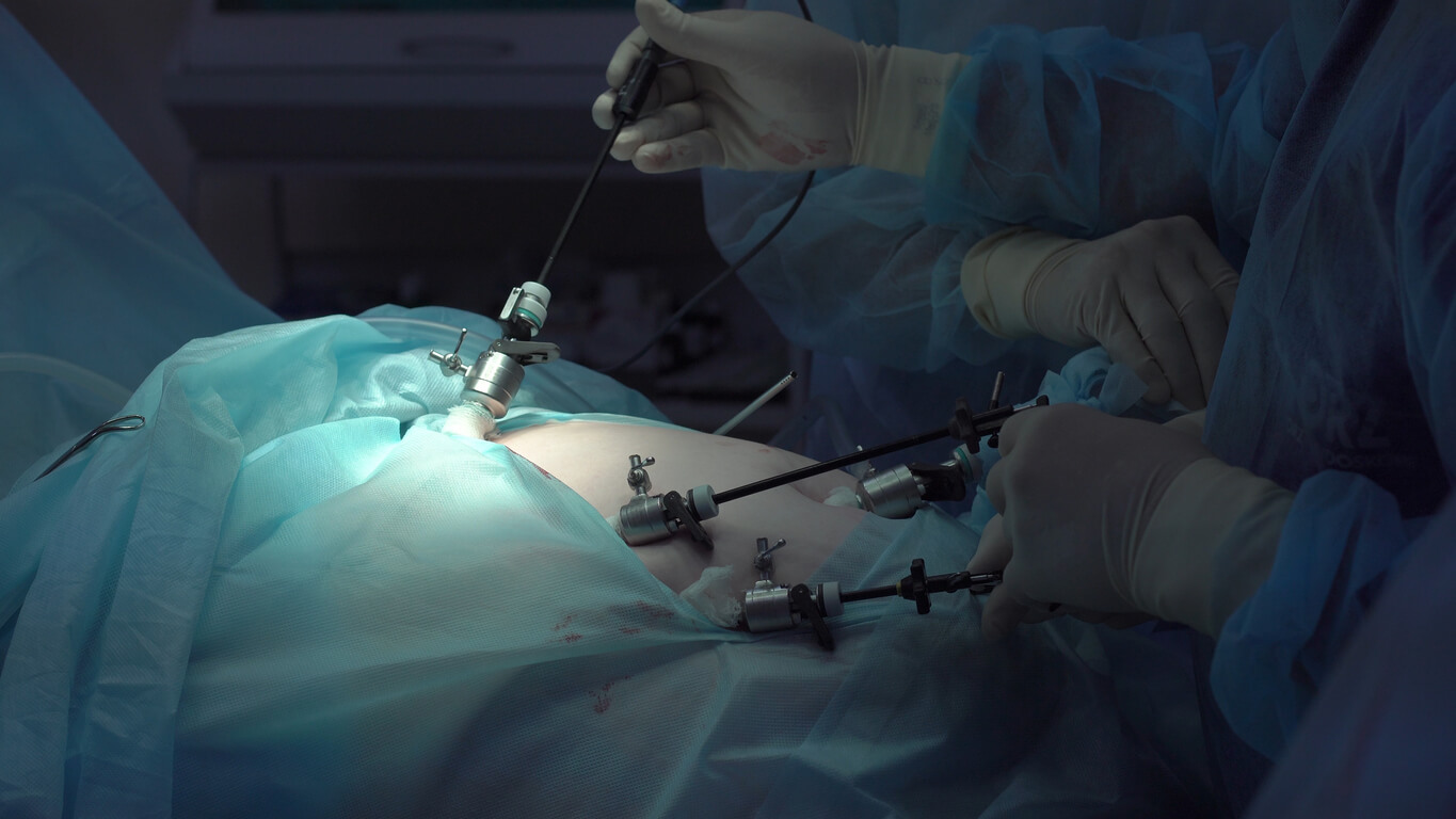 manos medico cirujano abdomen trocares laparoscopio