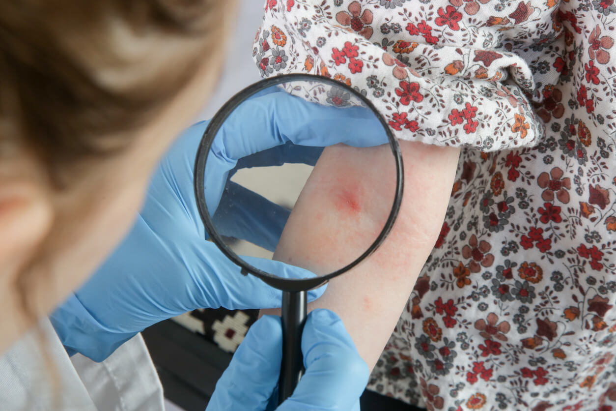 En lege som observerer atopisk dermatitt på et barns arm.