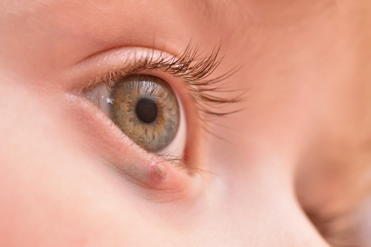 Orgelet sur l'oeil d'un enfant.