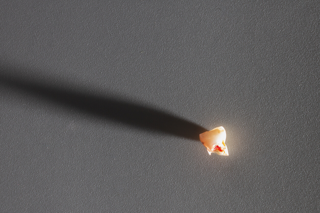 Caída prematura de un diente de leche: causas y consecuencias