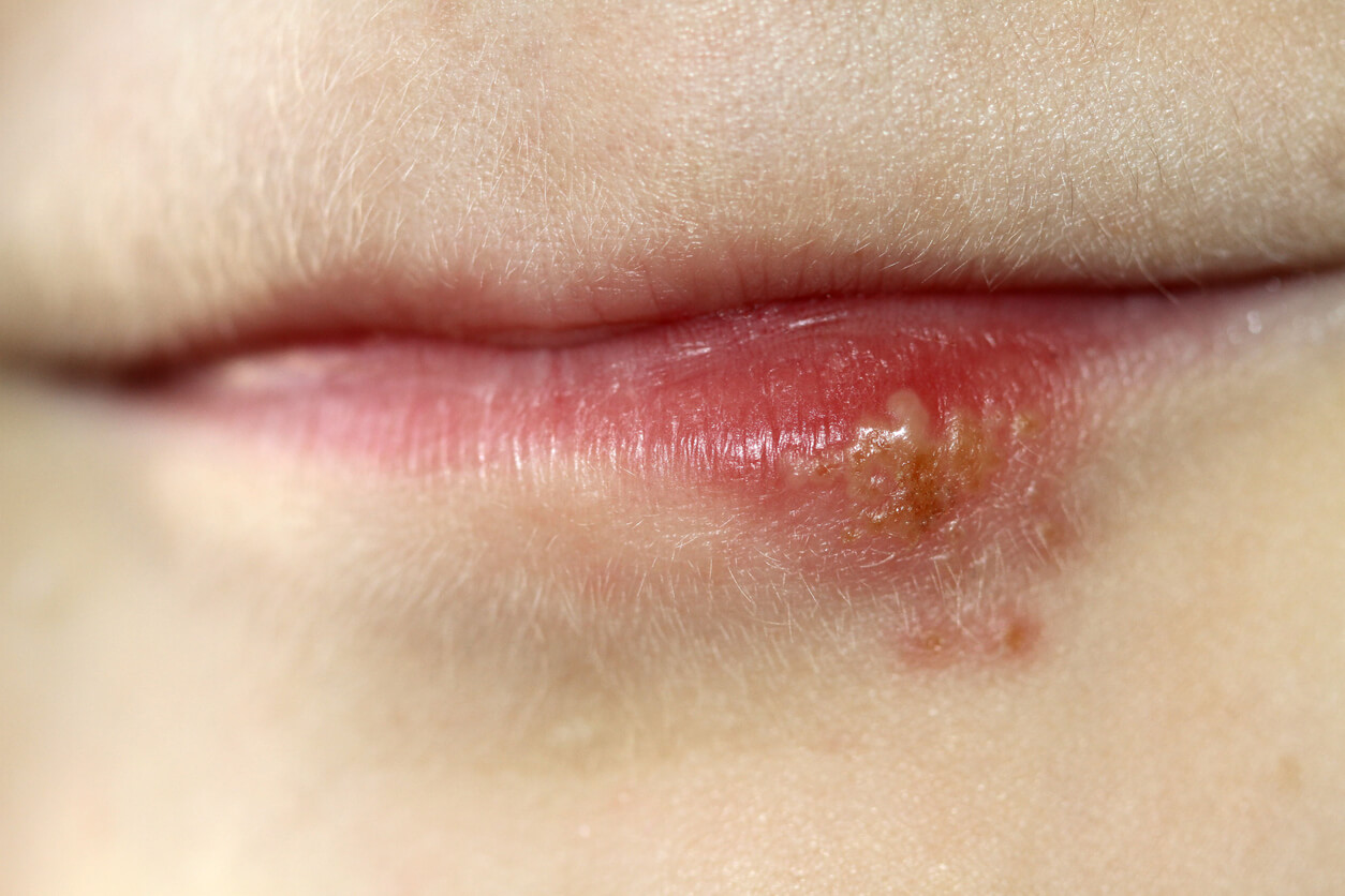 Herpes labial durante el embarazo: lo que debes saber