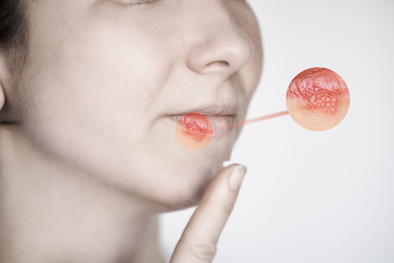 tratamiento crema aciclovir herpes labial vesiculas virus