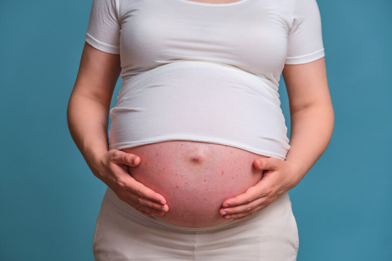 10 enfermedades de la piel durante el embarazo