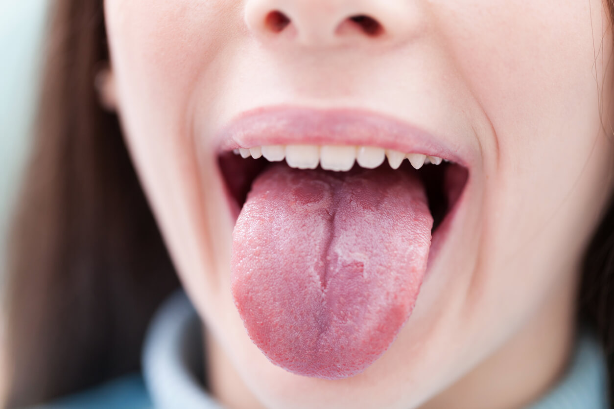 6 enfermedades infantiles con manifestaciones en la lengua