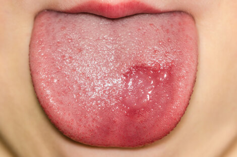 ¿Cómo saber si mi hijo tiene hongos en la lengua?
