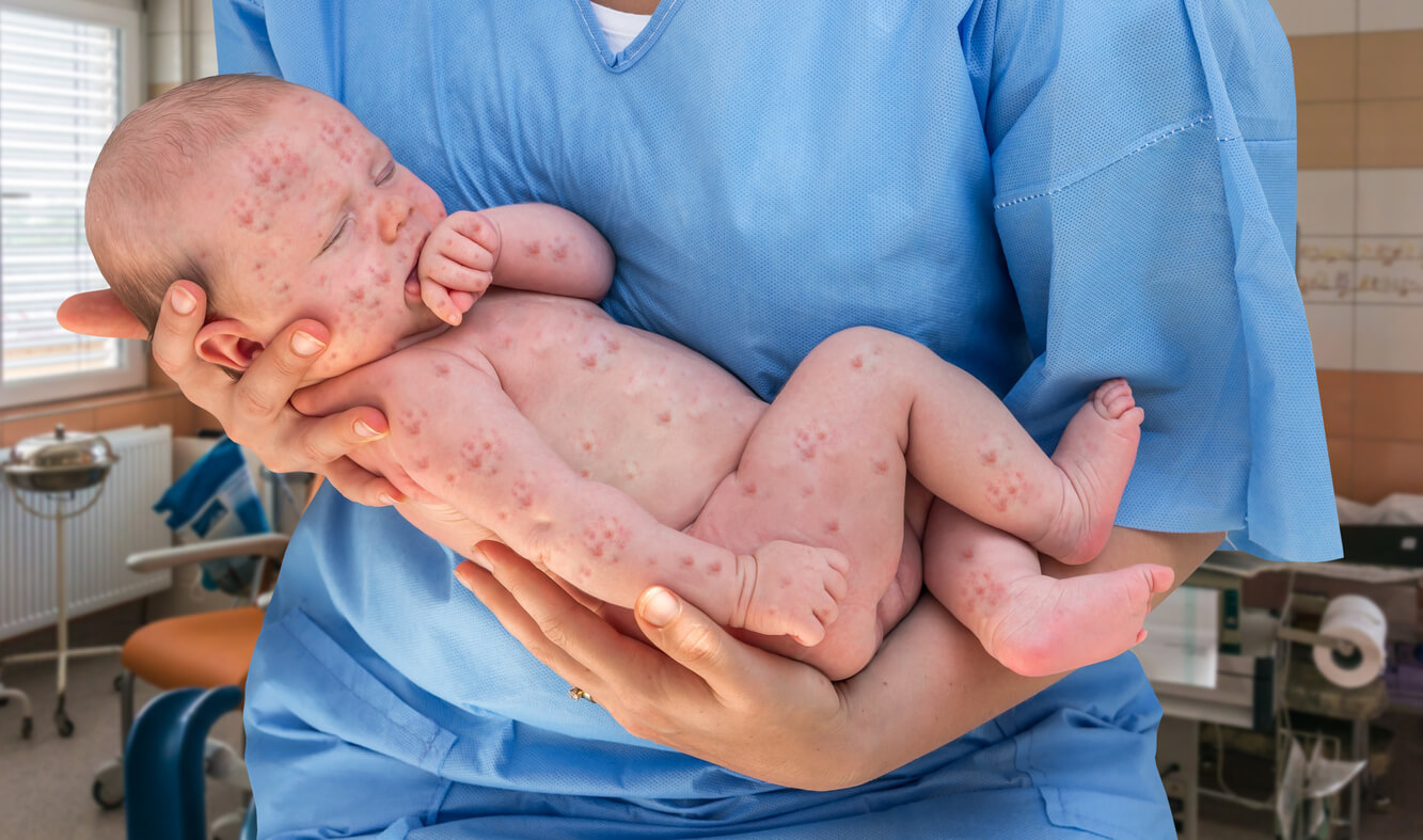 recien nacido brotado rash varicela sarampion rubeola citomegalovirus infeccion congenita TORCH