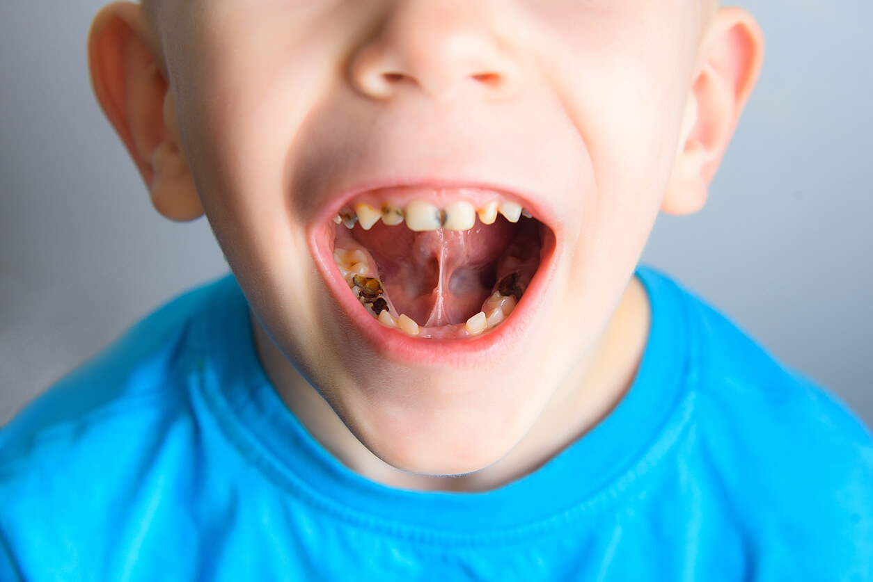 Een kind met gaatjes in de tanden