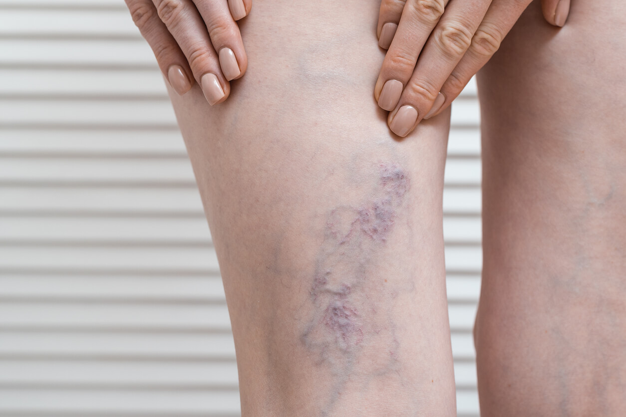 A woman with varicose veins.