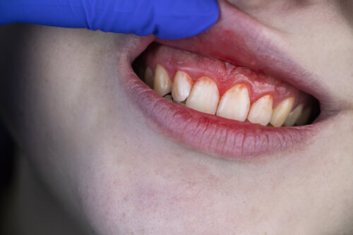 boca con encias inflamadas gingivitis sangrado lesion dedo guante dentista