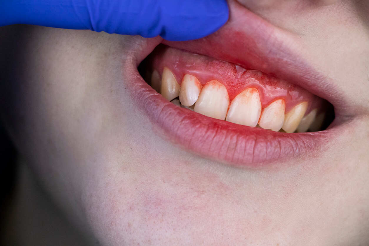 bouche avec gencives enflées gingivite saignement blessure doigt gant dentiste