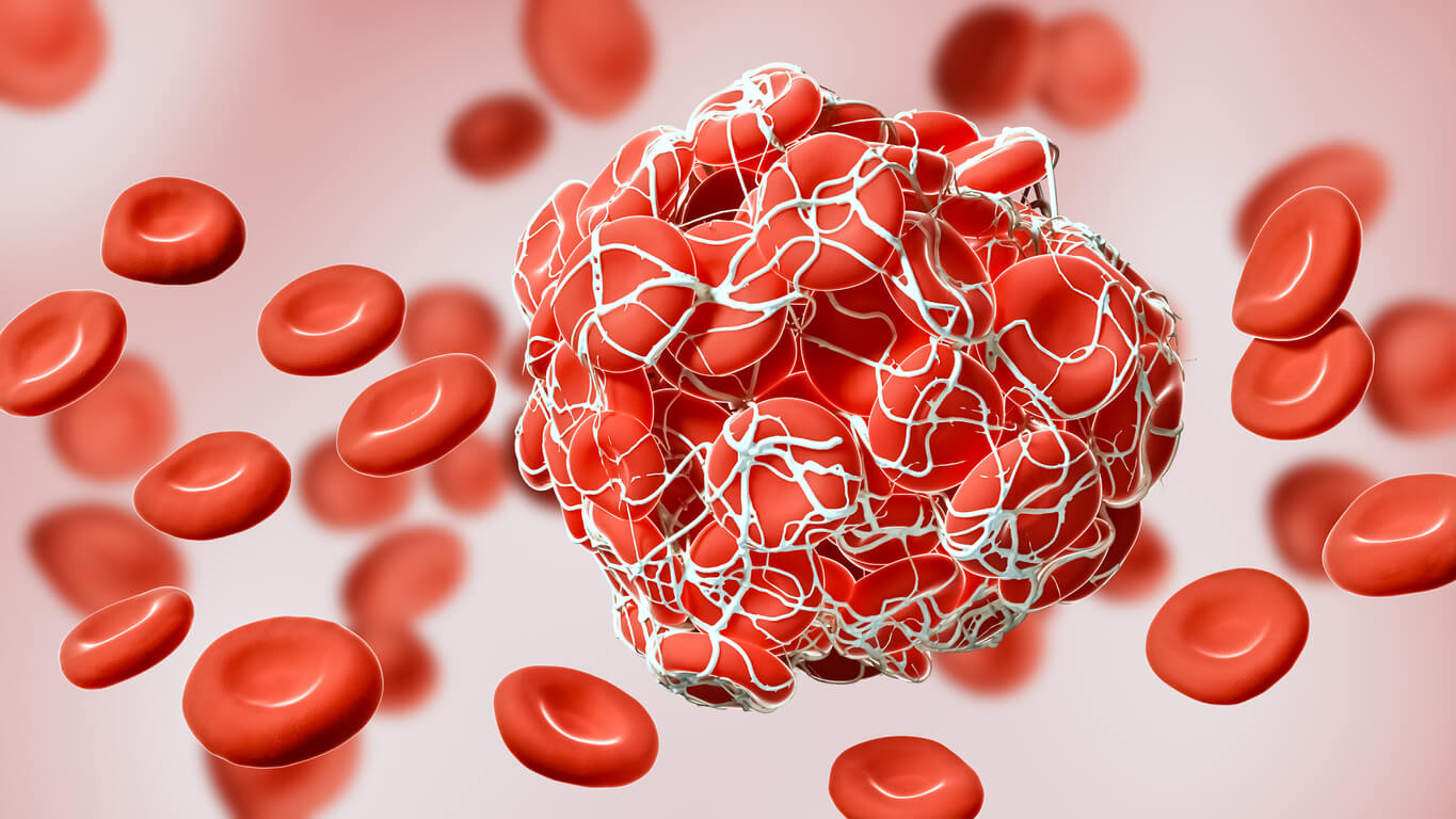 A digital image of a blood clot.