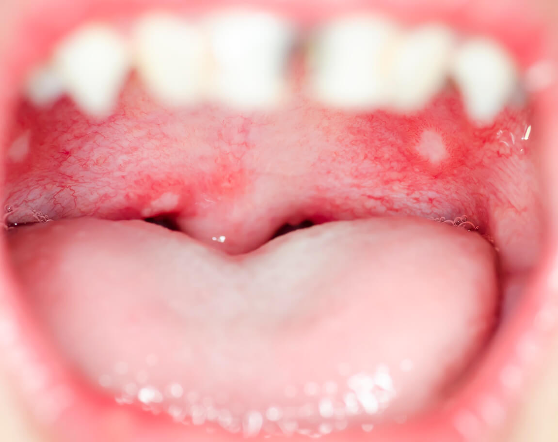 Mondinfecties bij kinderen kunnen zich uiten door middel van witte vlekjes in de mond.