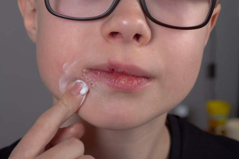 Herpes labial en niños: a qué se debe y cómo tratarlo
