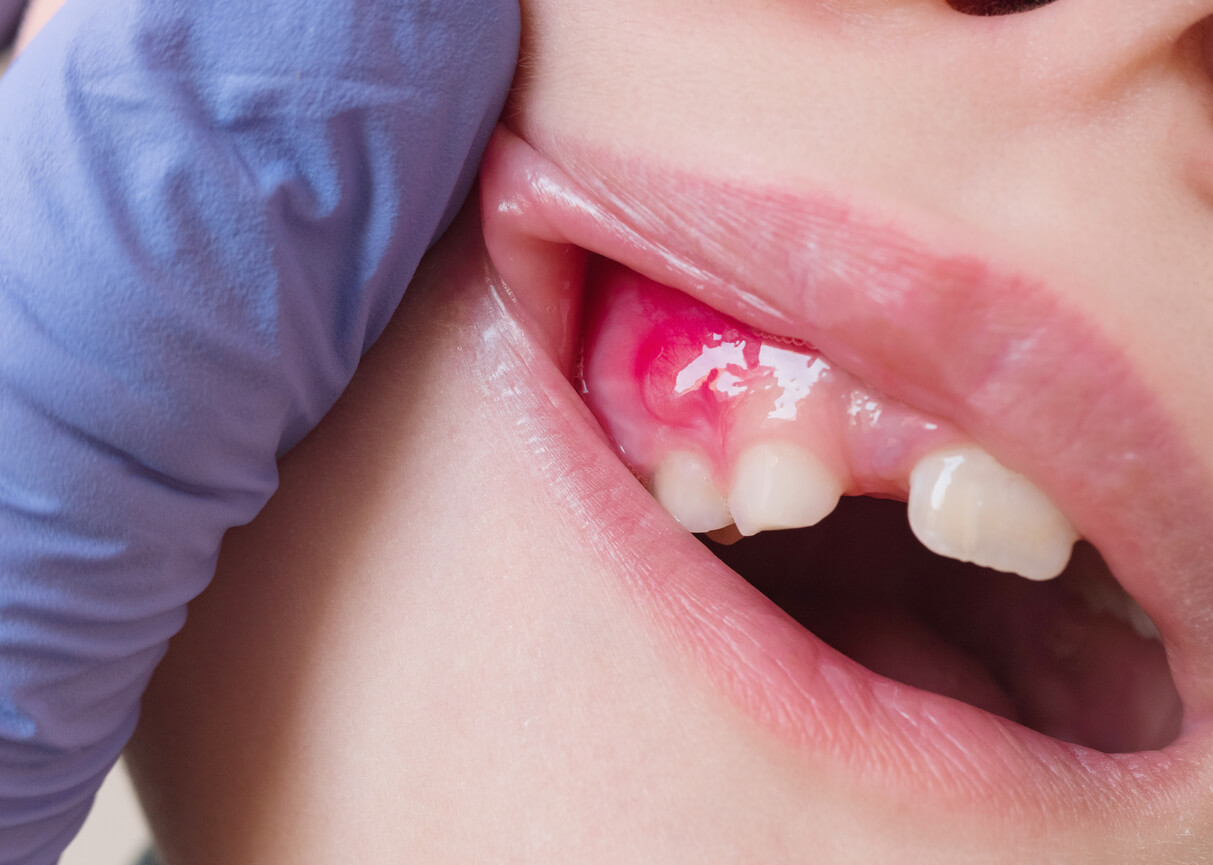 Lesão purulenta na gengiva da boca de uma criança