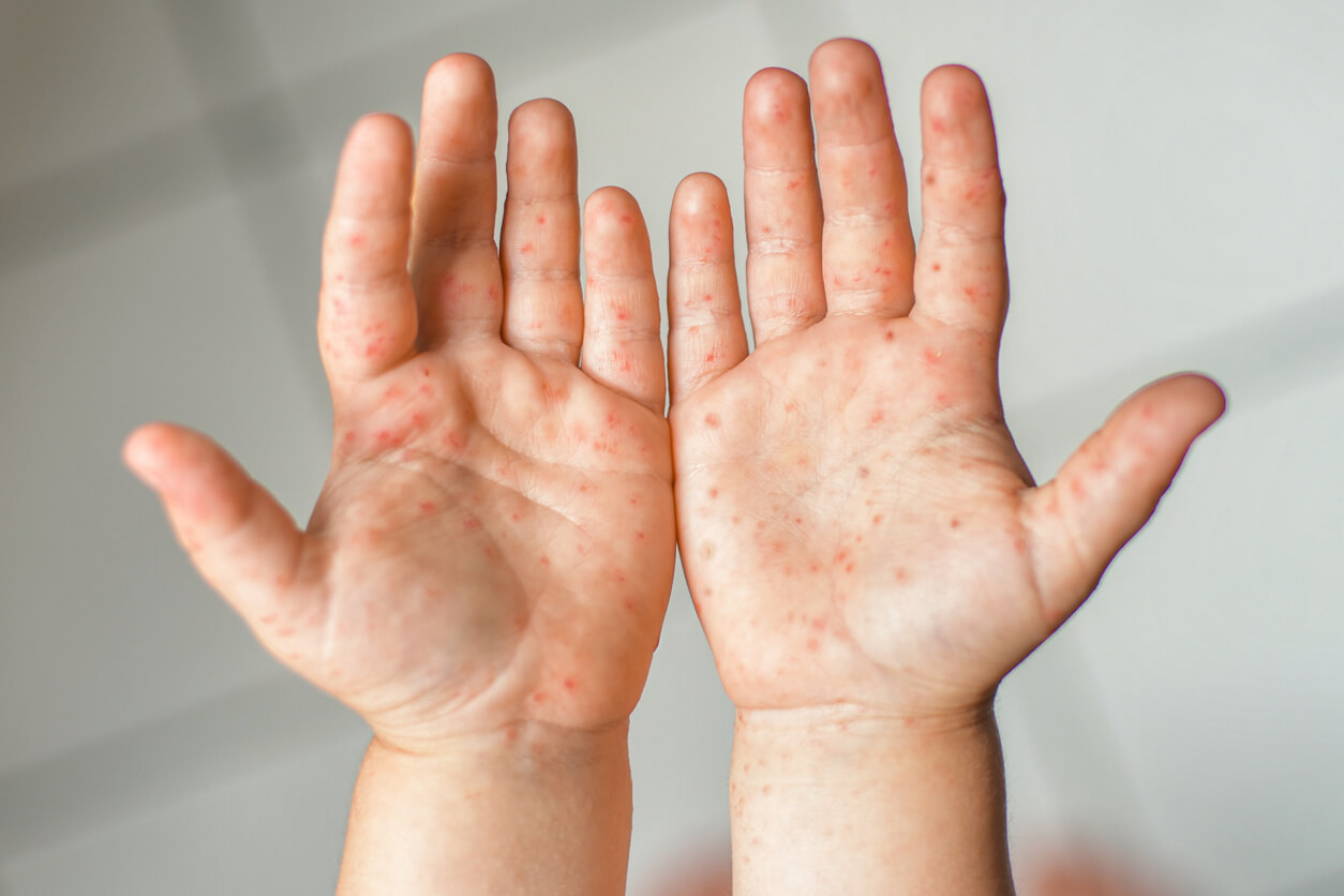 The hands of a child with hand foot and mouth disease.