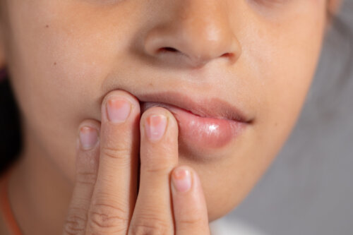 mujer mano en los labios edema