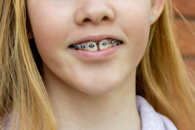 Diastemas o dientes separados en los niños: ¿por qué sucede?