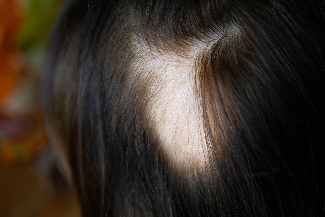 A person with a bald spot as a result of alopecia.