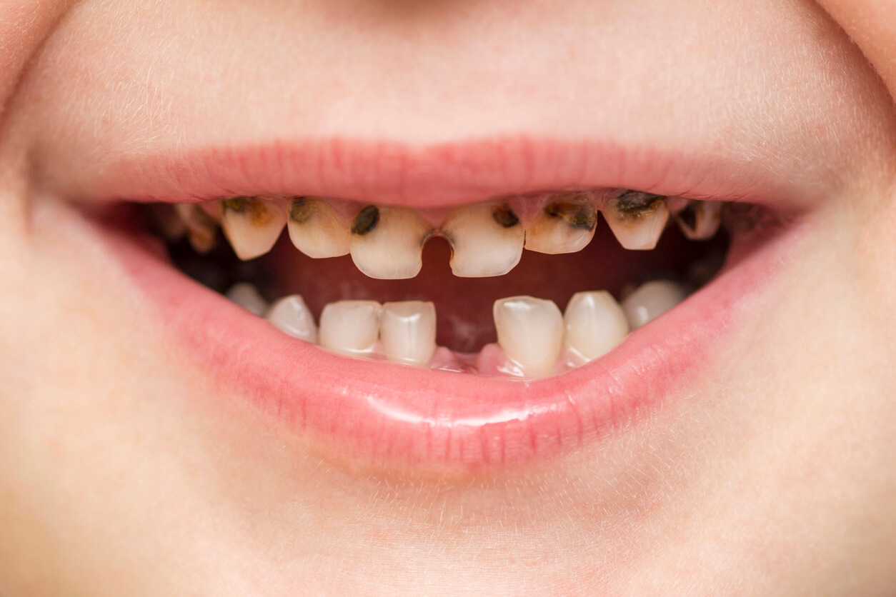 caries en dientes temporarios leche dentadura primaria