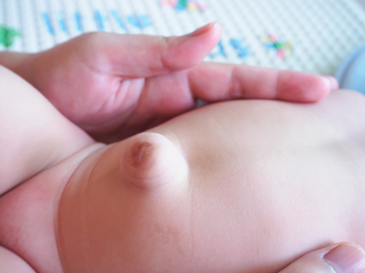 A baby with an umbilical hernia.