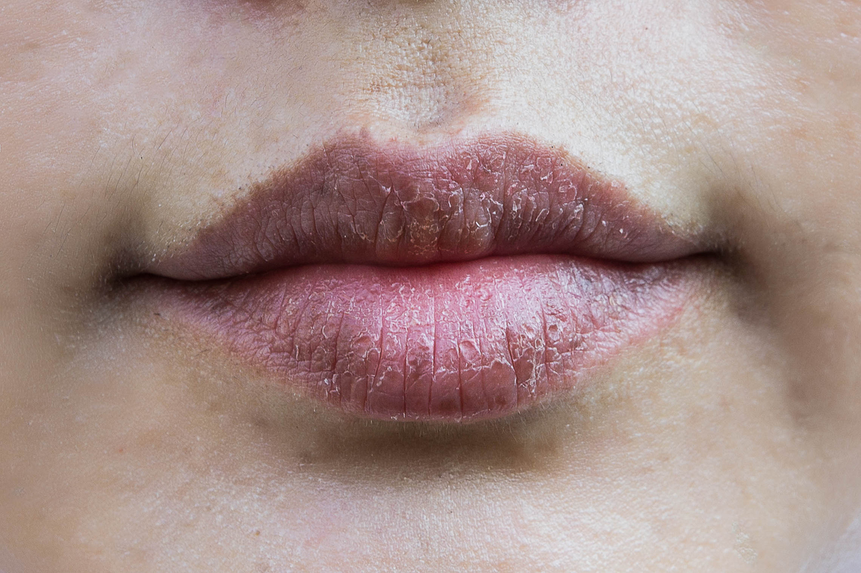 labios de mujer secos deshidratados agrietados